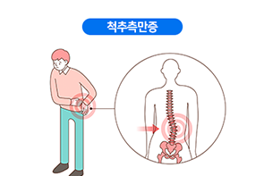 척추측만증