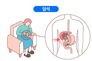 담석
